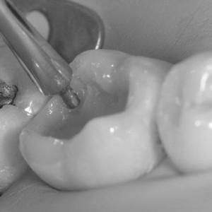 LM-Arte™ Posterior Misura